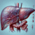 Liver Blood Test: Comprehensive Analysis Available in Tewkesbury